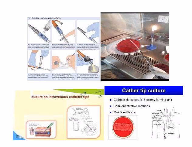 Can semiquantitative culture identify infection due to intravenous catheters?