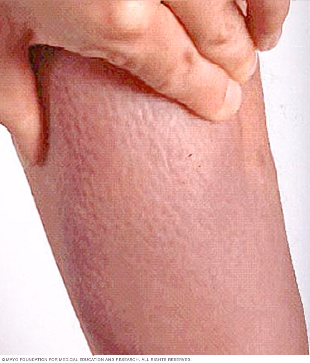 ¿Es posible la curación completa de la enfermedad de Hashimoto e hipotiroidismo?