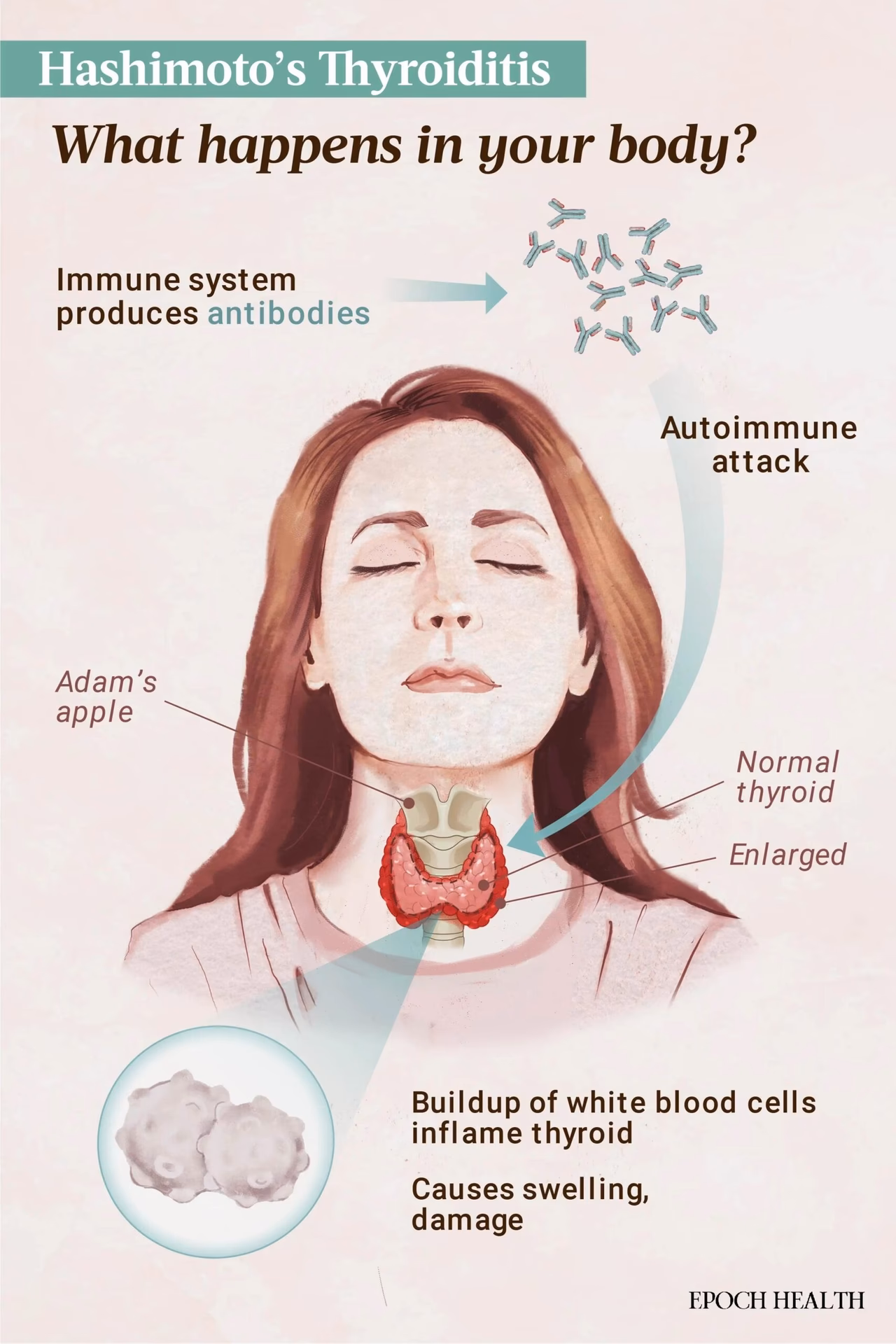 ¿Cuáles son los síntomas de la enfermedad de Hashimoto?