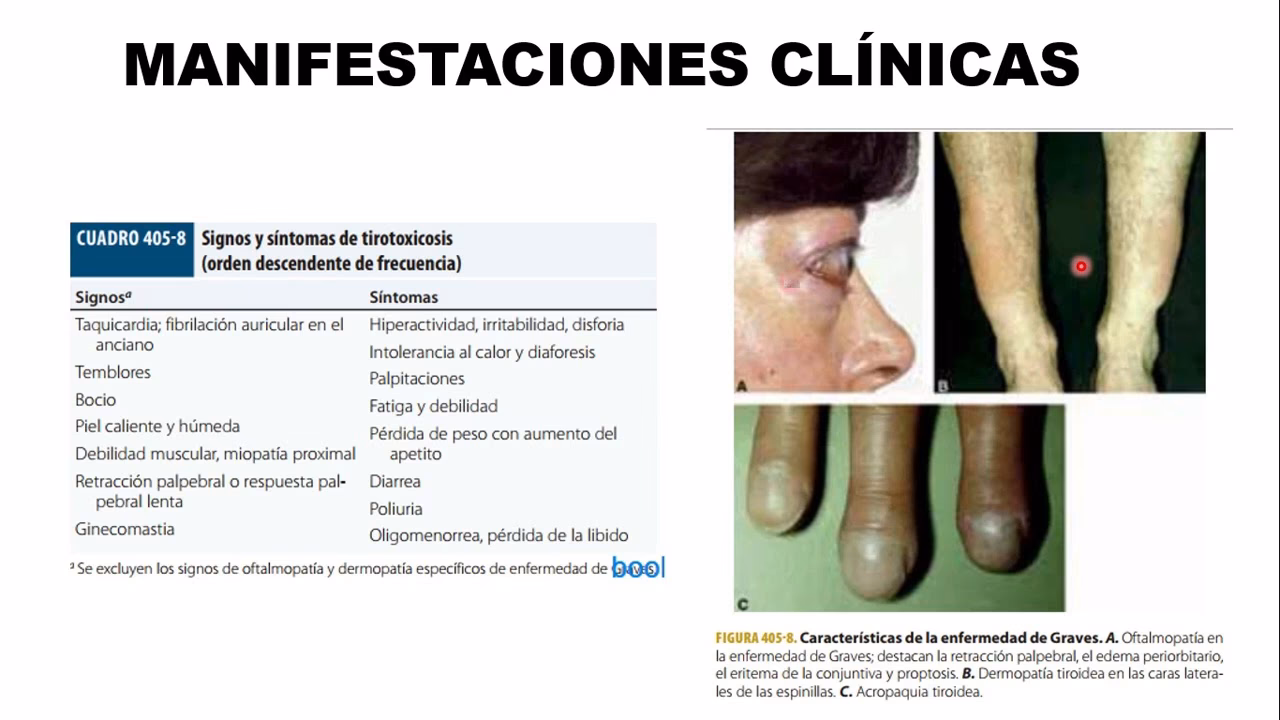 ¿Cómo diagnosticar la enfermedad de Hashimoto?